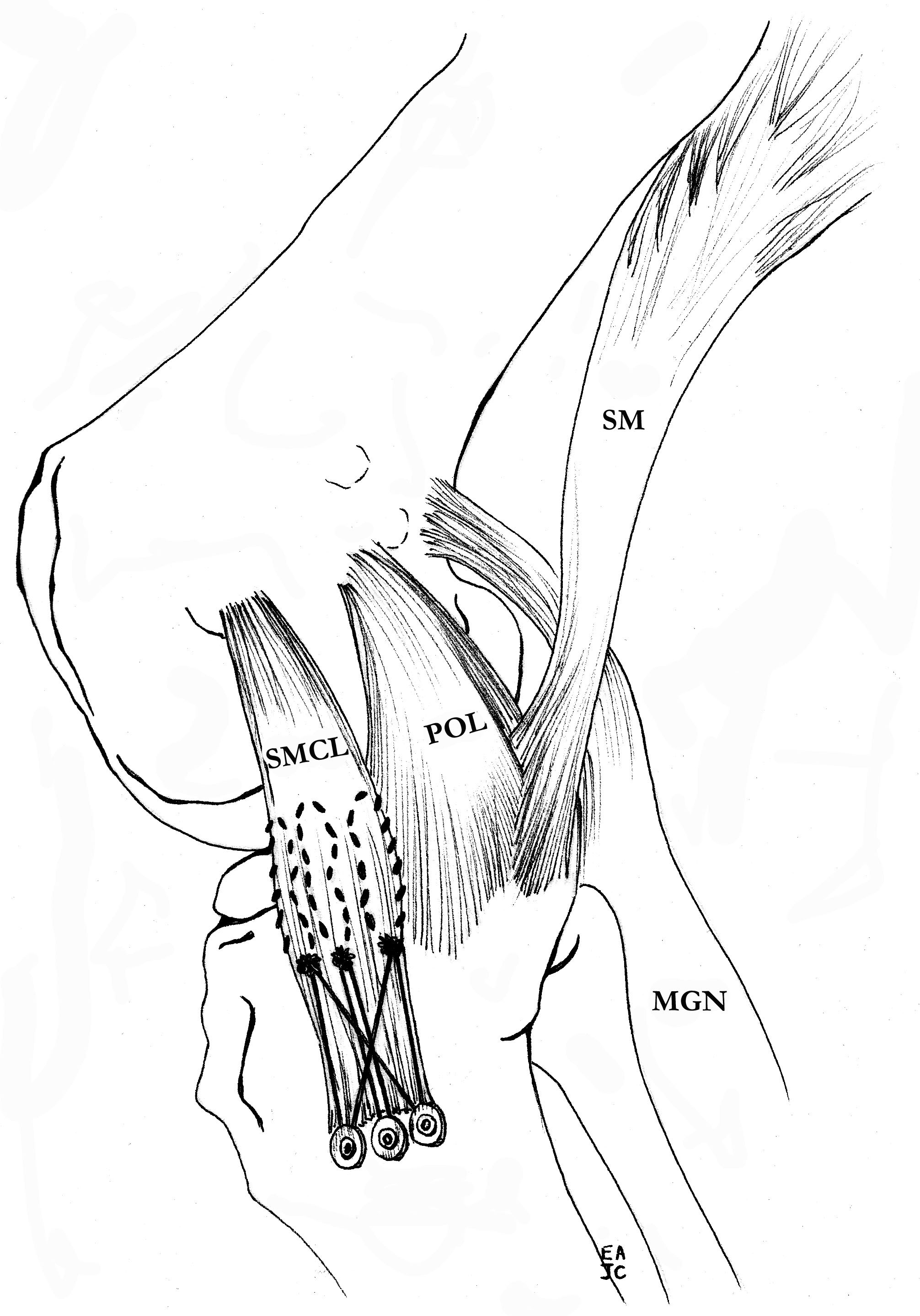 Distal tibial advancement repair MCL